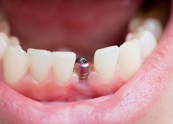 closeup of dental implant in mouth 