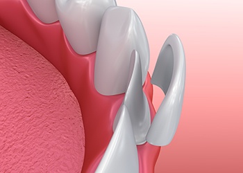 Illustration of veneer being placed on bottom tooth